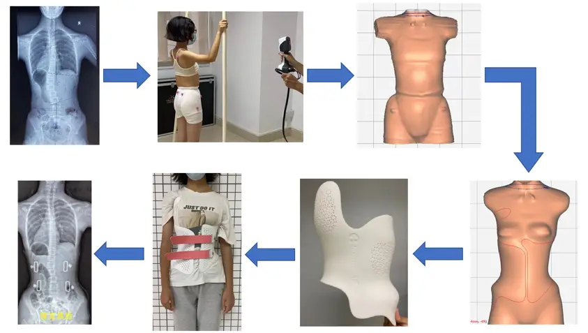 The Production Process of TPM3D SLS 3D Printing Spinal Orthosis Is Simple and The Wearing Experience Is Better.